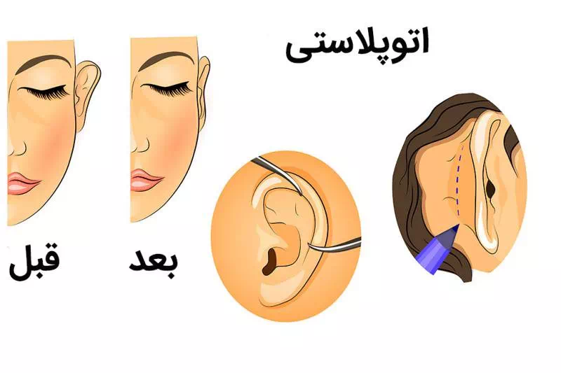 مراقبت های بعد از اتوپلاستی گوش